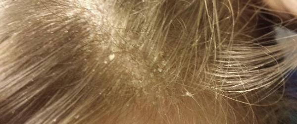 перхоть основные симптомы 1